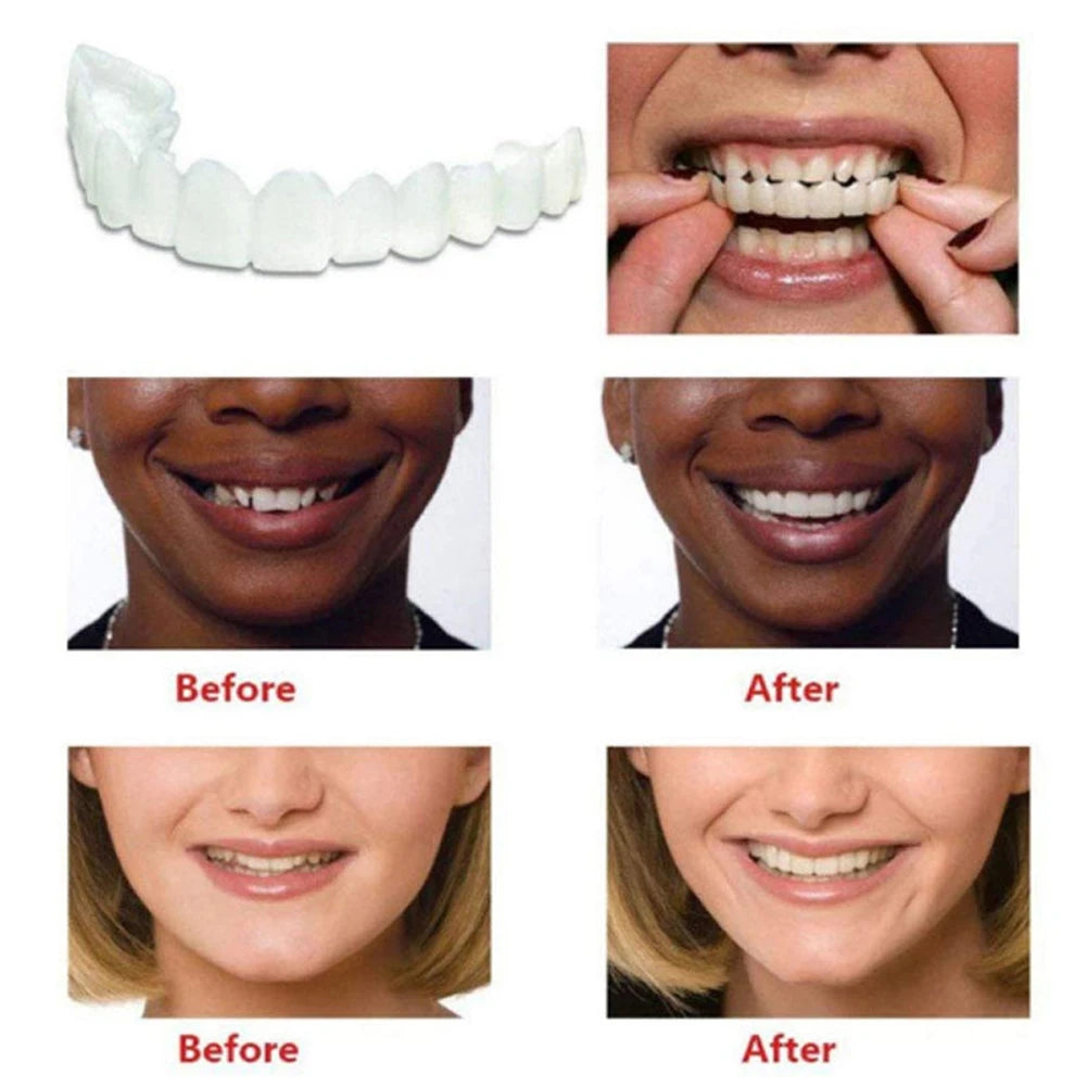 Cosmetic white dental veneers